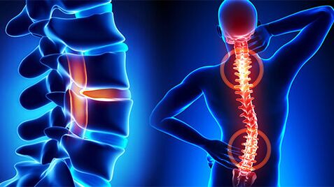 széles körben elterjedt osteochondrosis)